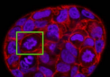 研究人员研究肿瘤细胞如何在人群中分裂