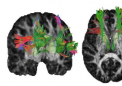 研究探讨健康大脑结构的变化如何影响认知