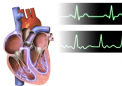 新方法确定致命心脏病的原因