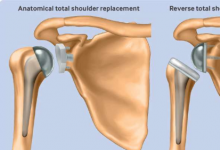 研究揭示了两种治疗骨关节炎的肩关节置换手术的争论