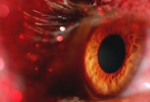 研究确定了与羟氯喹视网膜病变相关的因素