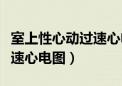 室上性心动过速心电图的表现（室上性心动过速心电图）