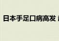 日本手足口病高发 超九成地区指标超警戒值