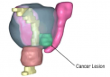 使用 3D 建模改善前列腺癌手术结果