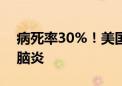 病死率30%！美国发现罕见致命病毒东方马脑炎