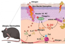 研究证实 IL-24 是特应性皮炎发生和进展的关键因素