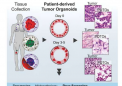 释放患者来源的类器官用于个性化肉瘤治疗的潜力